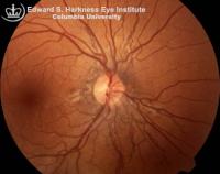 Angioid streaks demonstrating irregular concentric and some fine radial streaks associated with interconnected circular breaks near the optic disc. Peau d'orange pattern of RPE is also noted in the temporal midperiphery.